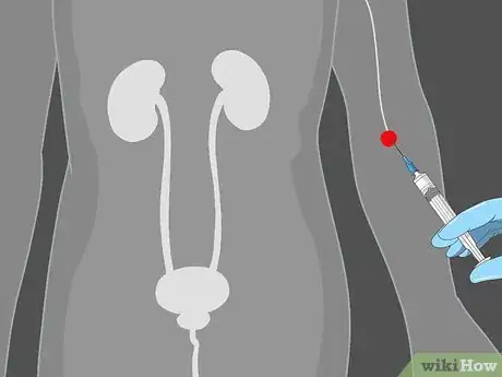 Image titled Diagnose Bladder Cancer Step 11