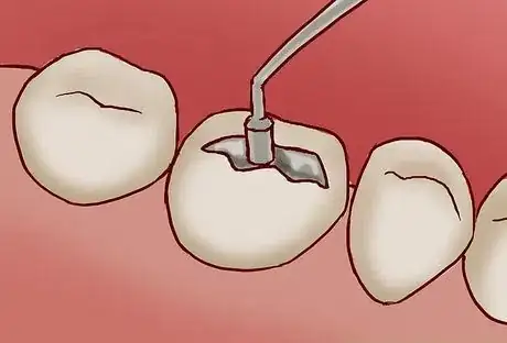 Image titled Go for gum lifting