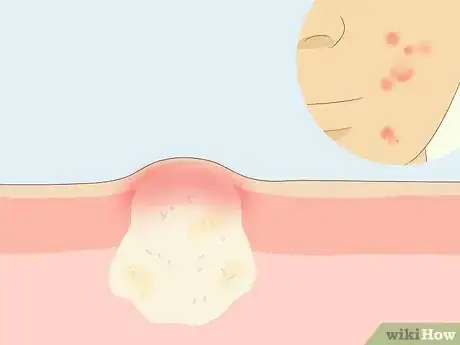 Image titled Treat Adult Acne Step 13