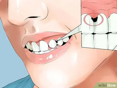 Image titled Identify if You Have Sensitive Teeth Step 9