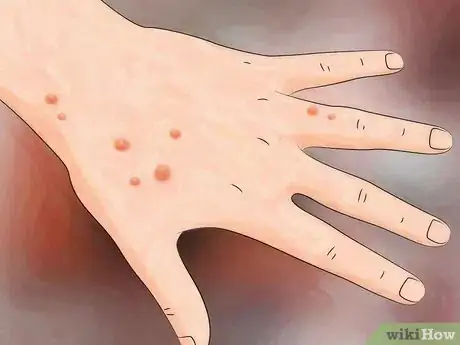 Image titled Identify Fire Ant Stings Step 2