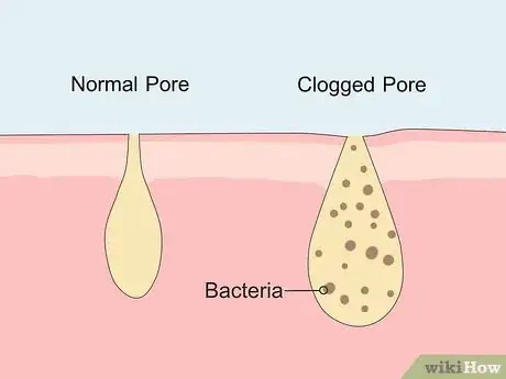 Image titled Prevent Cystic Acne Step 5