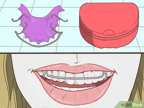 Image titled Straighten Your Teeth Without Braces Step 14