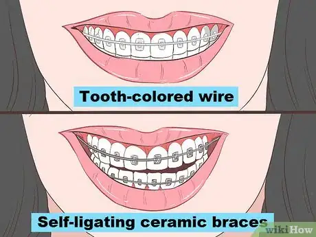 Image titled Look Good in Ceramic Braces Step 8