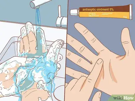 Image titled Treat a Blood Blister Step 13