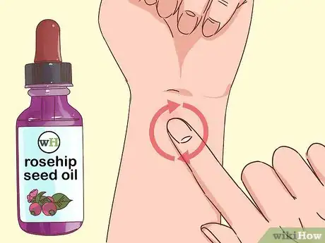 Image titled Reduce the Appearance of Old Scars Step 5