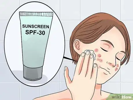 Image titled Get Rid of Acne if You Have Fair Skin Step 15