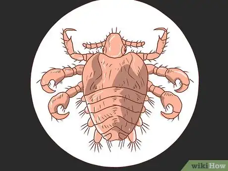 Image titled Treat Crabs (Pubic Lice) Step 1