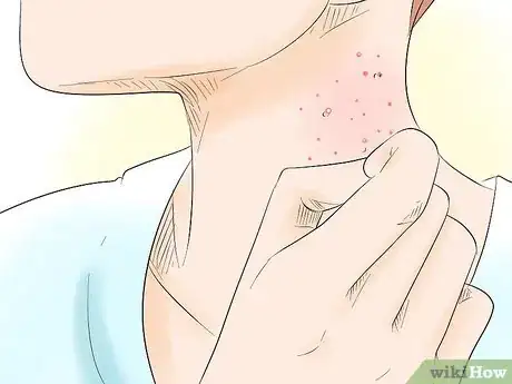 Image titled Stop Picking Your Face Step 15