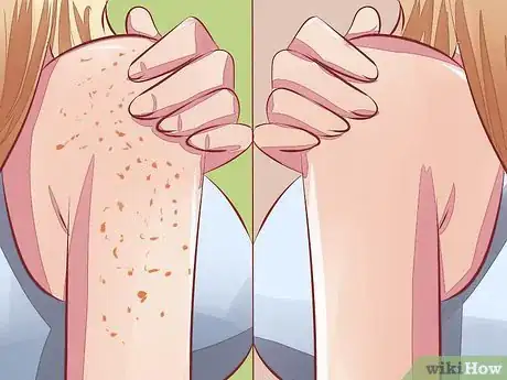 Image titled Avoid Skin Pigmentation During Pregnancy Step 12