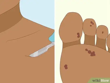 Image titled Diagnose Infective Endocarditis Step 3