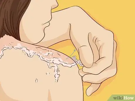 Image titled Treat Sunburn with Natural Remedies Step 6