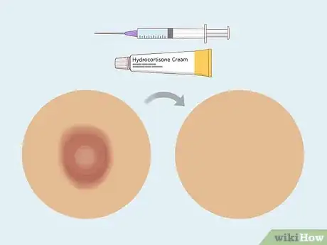 Image titled Prevent Cystic Acne Step 12