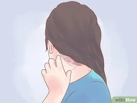 Image titled Treat Plaque Psoriasis Step 25
