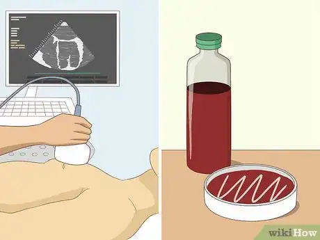Image titled Diagnose Infective Endocarditis Step 6