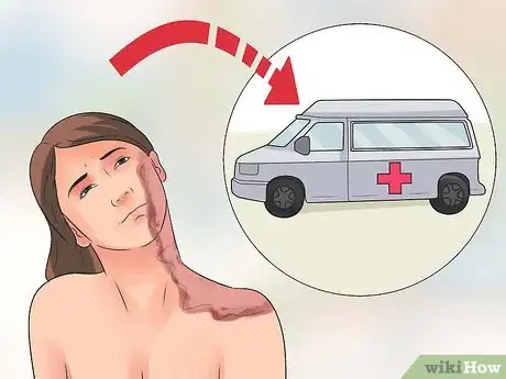 Image titled Treat a Hot Water Spill on Your Skin Step 6