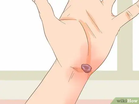 Image titled Treat a Blood Blister Step 18