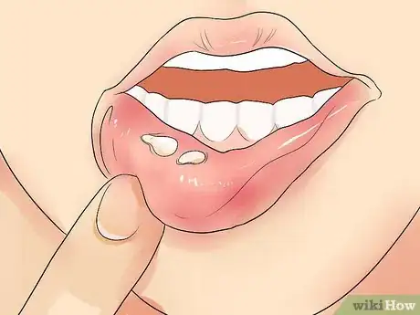 Image titled Recognize Herpes Step 1