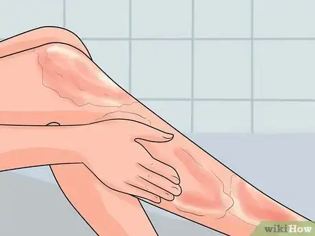 Image titled Treat a Hot Water Spill on Your Skin Step 5