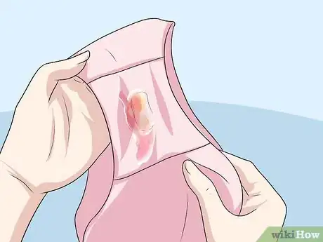 Image titled Recognize Chlamydia Symptoms (for Women) Step 1