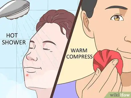 Image titled Get Rid of a Pimple Step 11