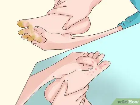 Image titled Treat Trench Foot Step 6