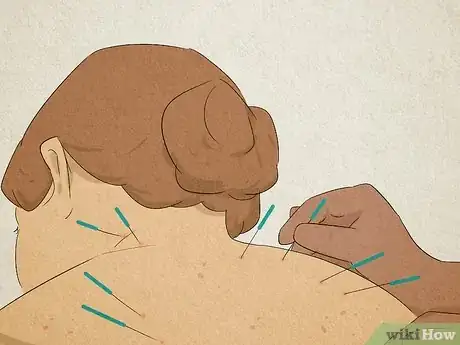 Image titled Find a Licensed Acupuncturist Step 4