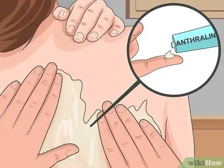 Image titled Soothe Psoriasis Flares Step 4