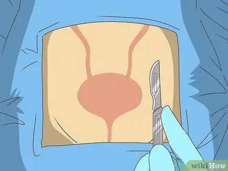 Image titled Diagnose Bladder Cancer Step 16