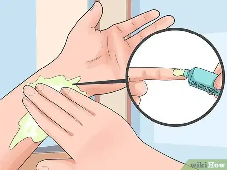 Image titled Soothe Psoriasis Flares Step 3