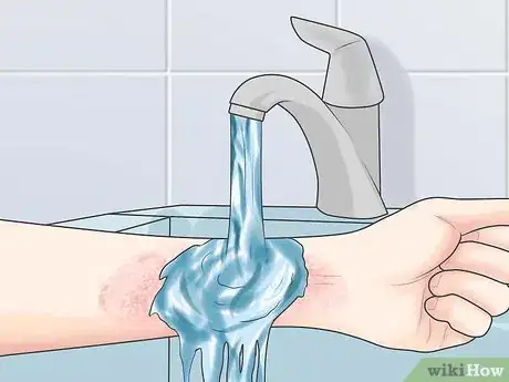 Image titled Soothe Psoriasis Flares Step 6