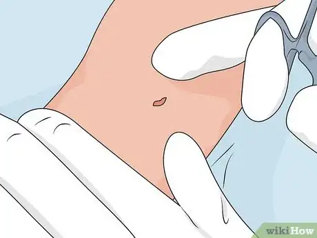 Image titled Remove Nexplanon Step 02