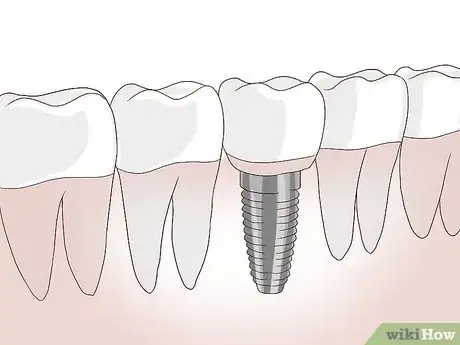 Image titled Know What to Expect when Getting a Tooth Implant Step 2