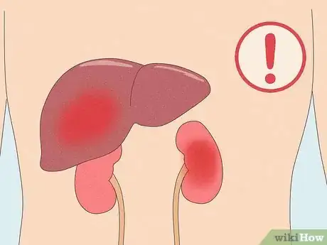 Image titled Treat Cancer with Cannabis Step 13