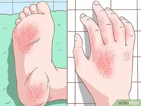 Image titled Handle an Eczema Flare Up Step 3