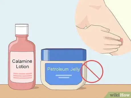 Image titled Soothe Itchy Legs Step 8