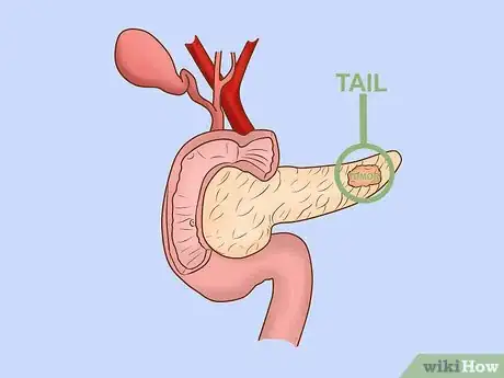 Image titled Treat Pancreatic Cancer Step 4