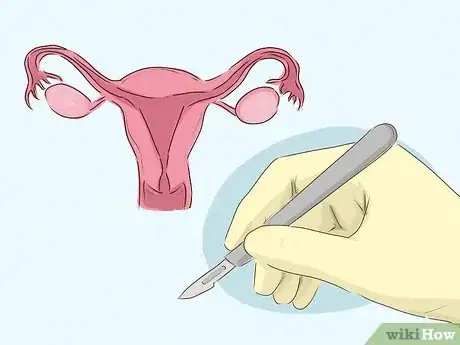 Image titled Decide Whether or Not to Have Preventive Breast Surgery Step 8