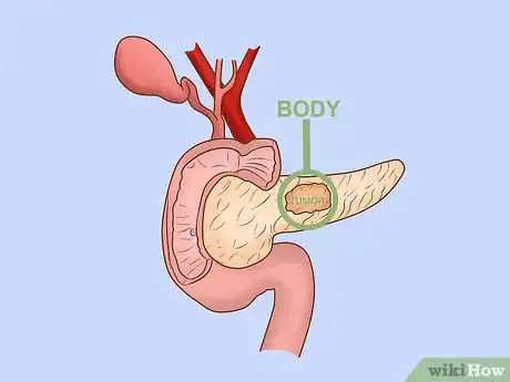 Image titled Treat Pancreatic Cancer Step 3