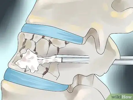 Image titled Treat Compression Fractures with Back Surgery Step 5