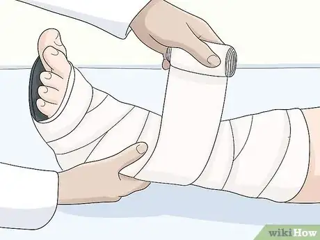 Image titled Identify Lymphedema Step 16