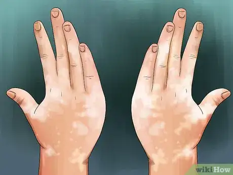 Image titled Diagnose Vitiligo Step 2