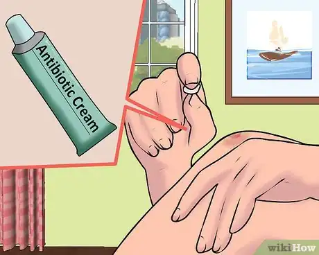 Image titled Use a Band Aid Step 2