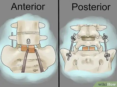 Image titled Treat Compression Fractures with Back Surgery Step 6