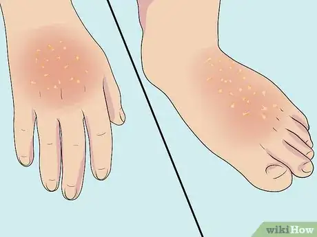 Image titled Diagnose Erythrodermic Psoriasis Step 10