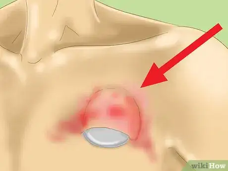 Image titled Prevent Staph Blood Infections Step 10
