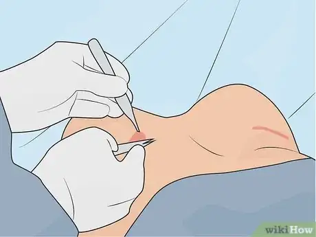 Image titled Maintain Your Plastic Surgery Results Step 14