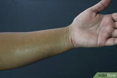 Image titled Soothe Bites and Stings with Vodka Step 6