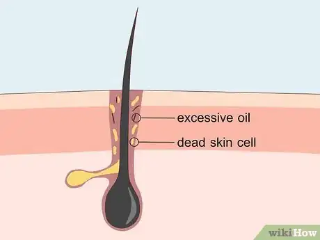 Image titled Treat Adult Acne Step 5