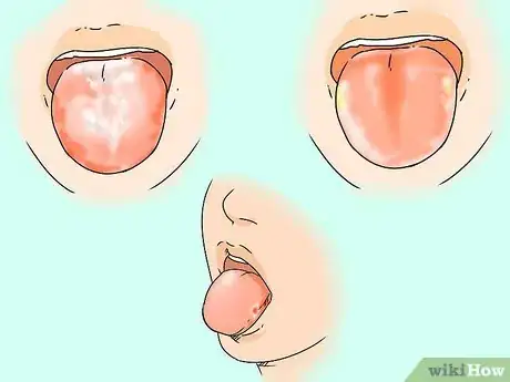 Image titled Get Rid of White Tongue Step 13